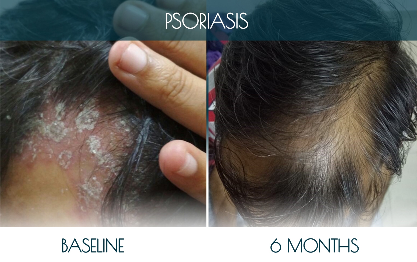 Befor-after PSORIASIS