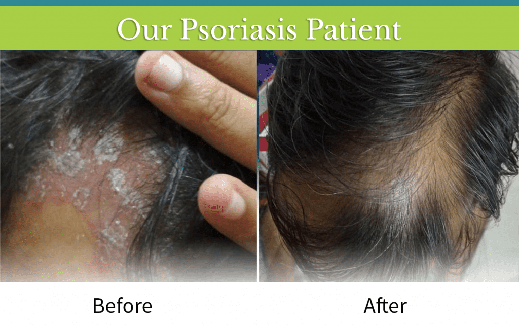 Befor-after_PSORIASIS