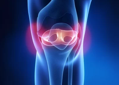 Radial Lateral Meniscus Tears