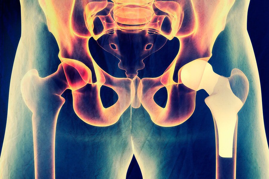 Treatment for hip arthritis without surgery