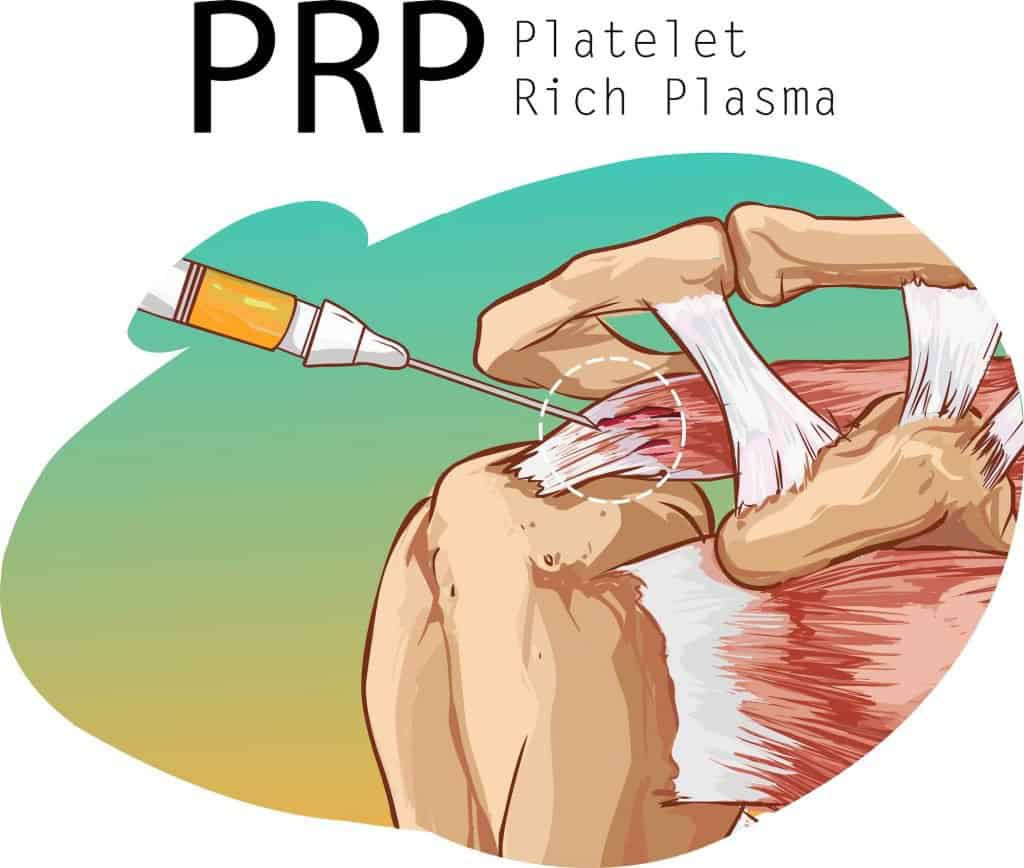 PRP for Shoulder Impingement