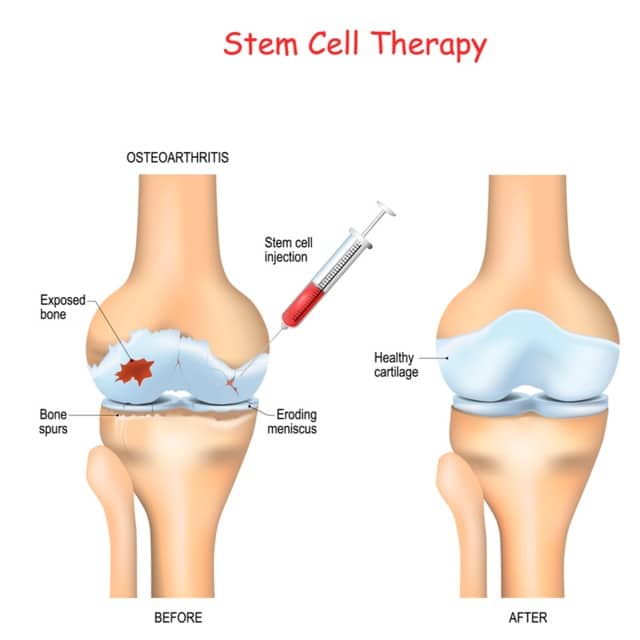 stem cell knee