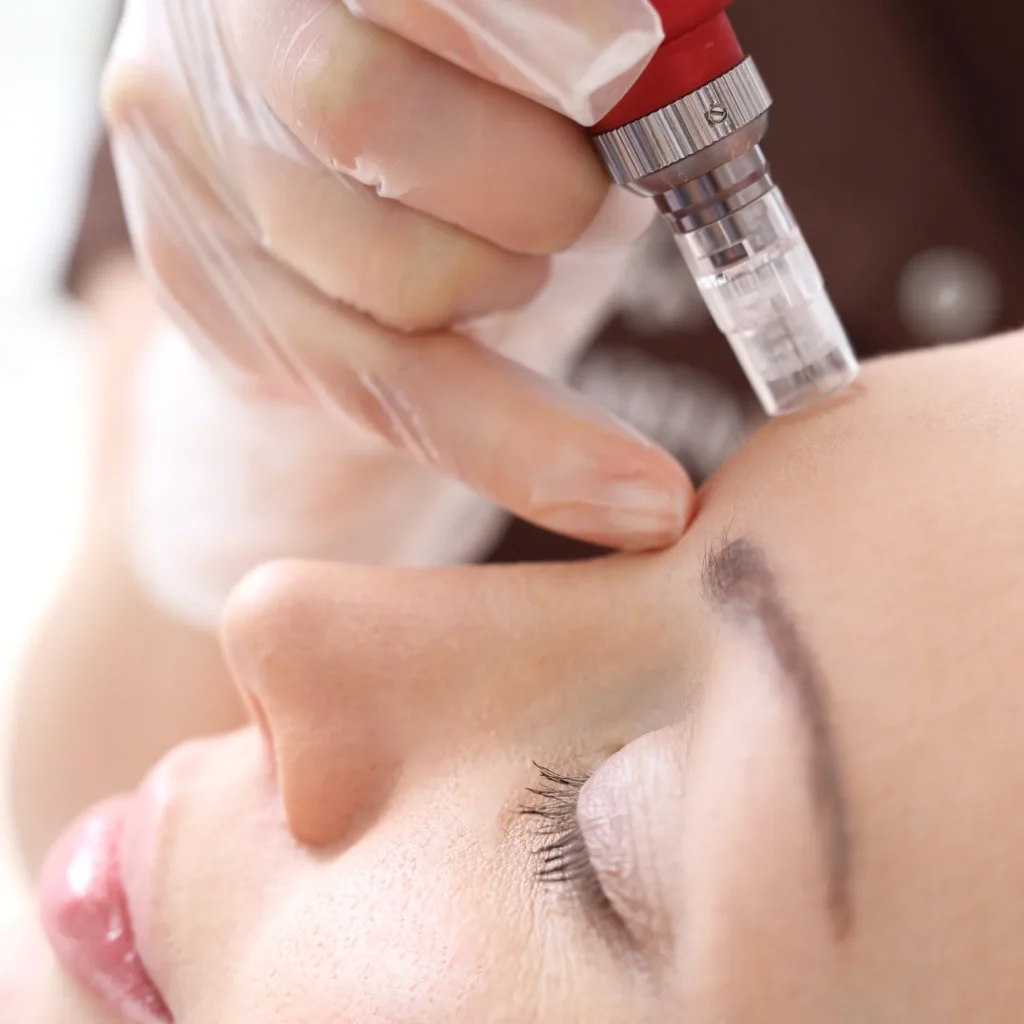 Micro-Needling Therapy 2